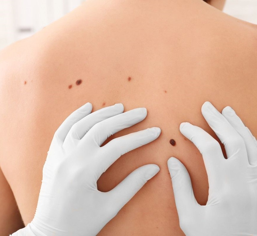 usuwanie zmian skórnych