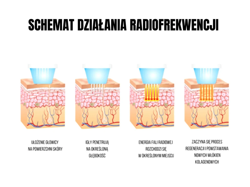 radiofrekwencja mikroigłowa rf Łomża